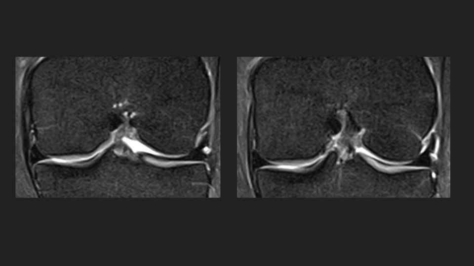Figure 4 for case meniscofemoral ligament ( RID2806 )